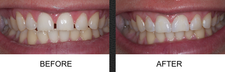 Dental Crowns