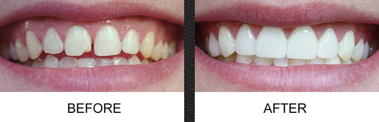 Dental Veneers