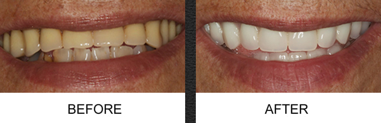 Dental Veneers