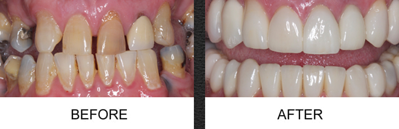 Full Mouth Reconstruction