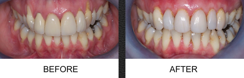 Gum Grafting